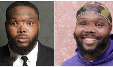 Young man who sustained face injury in an accident survives, bags Criminal Justice degree at US university